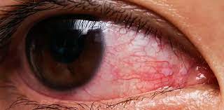 Uveitis and Ocular Inflammation